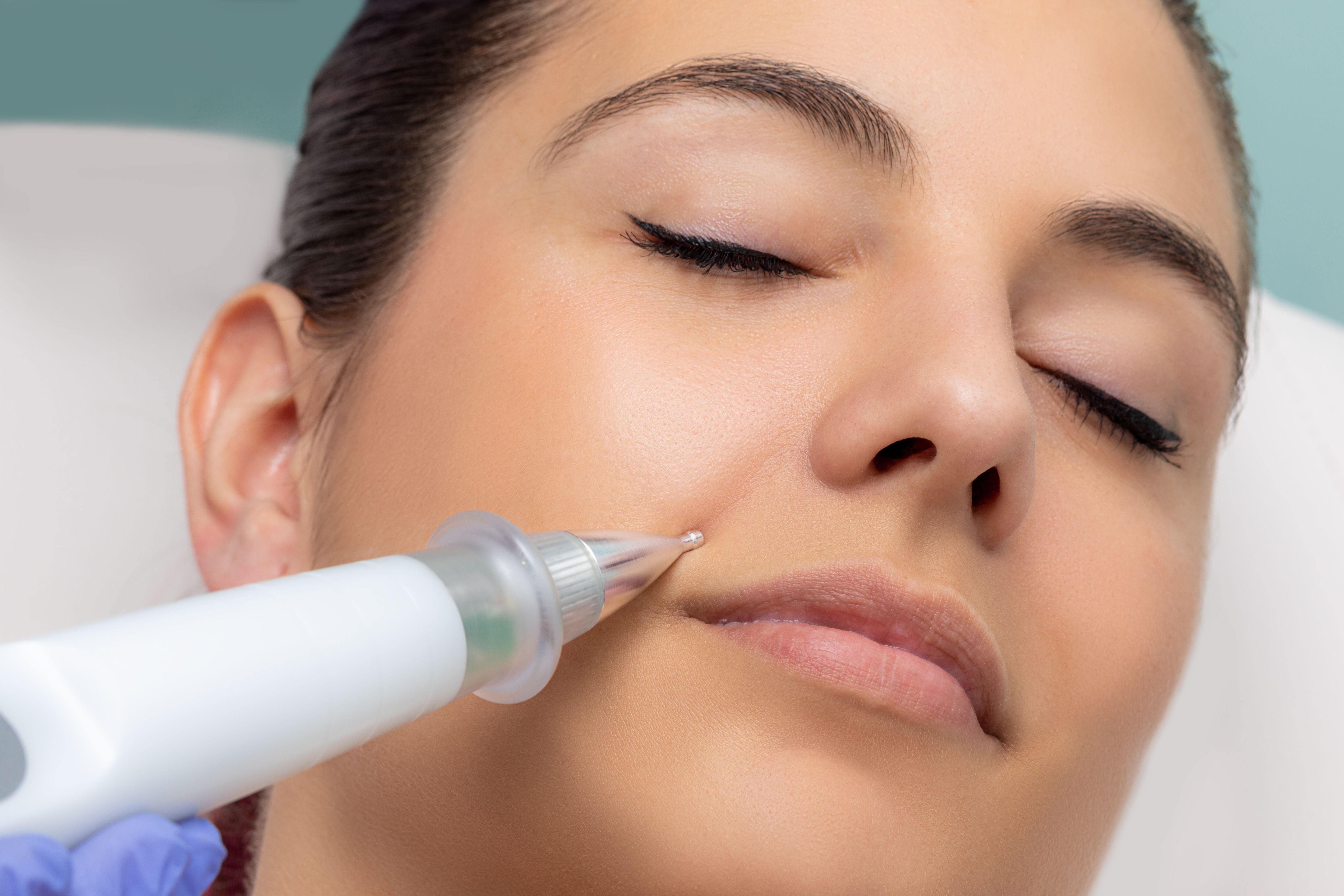 How Does the Plasma Pen Remove Wrinkles and Fine Lines