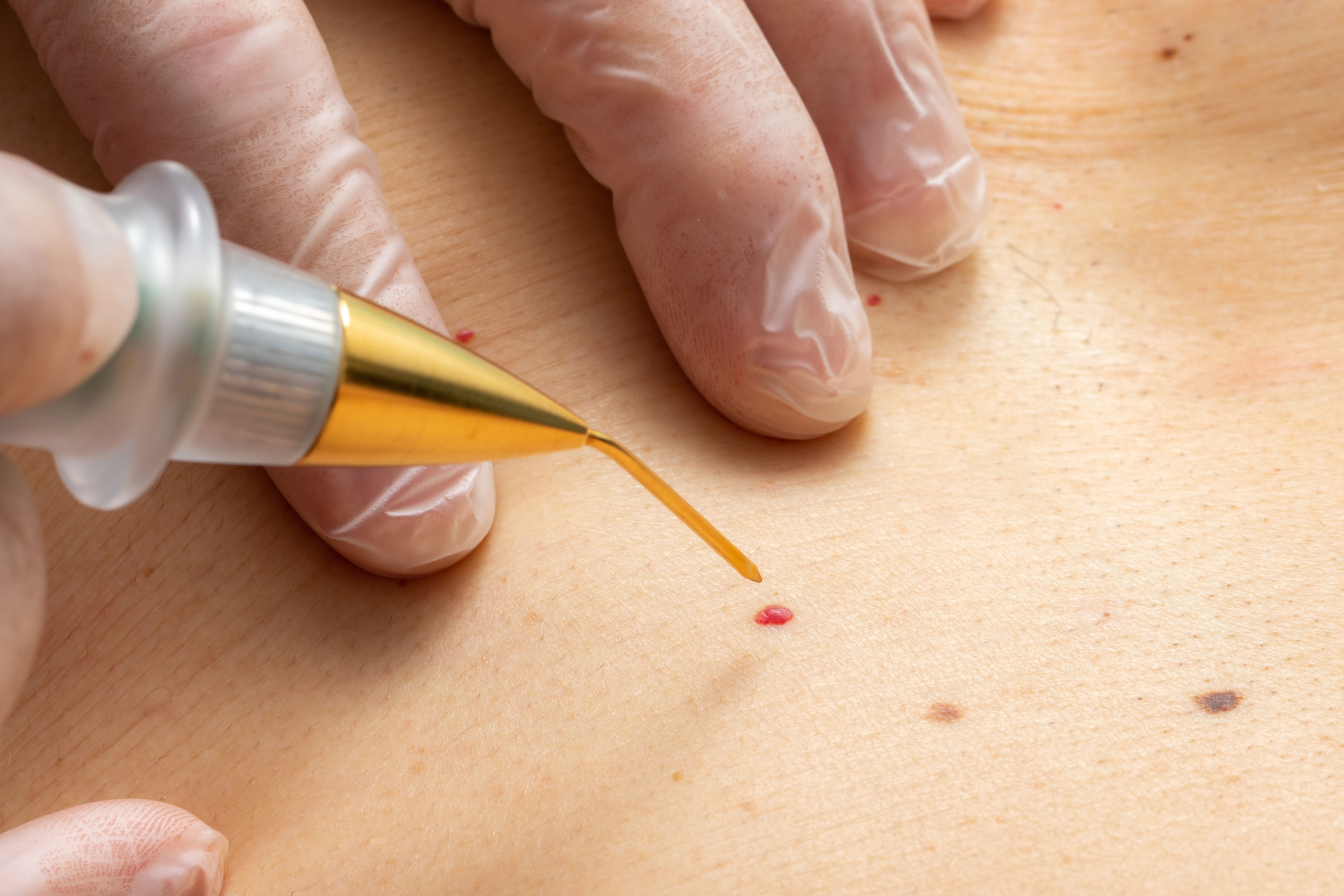 Top Tips for the Right Skin Tag Removal Kit