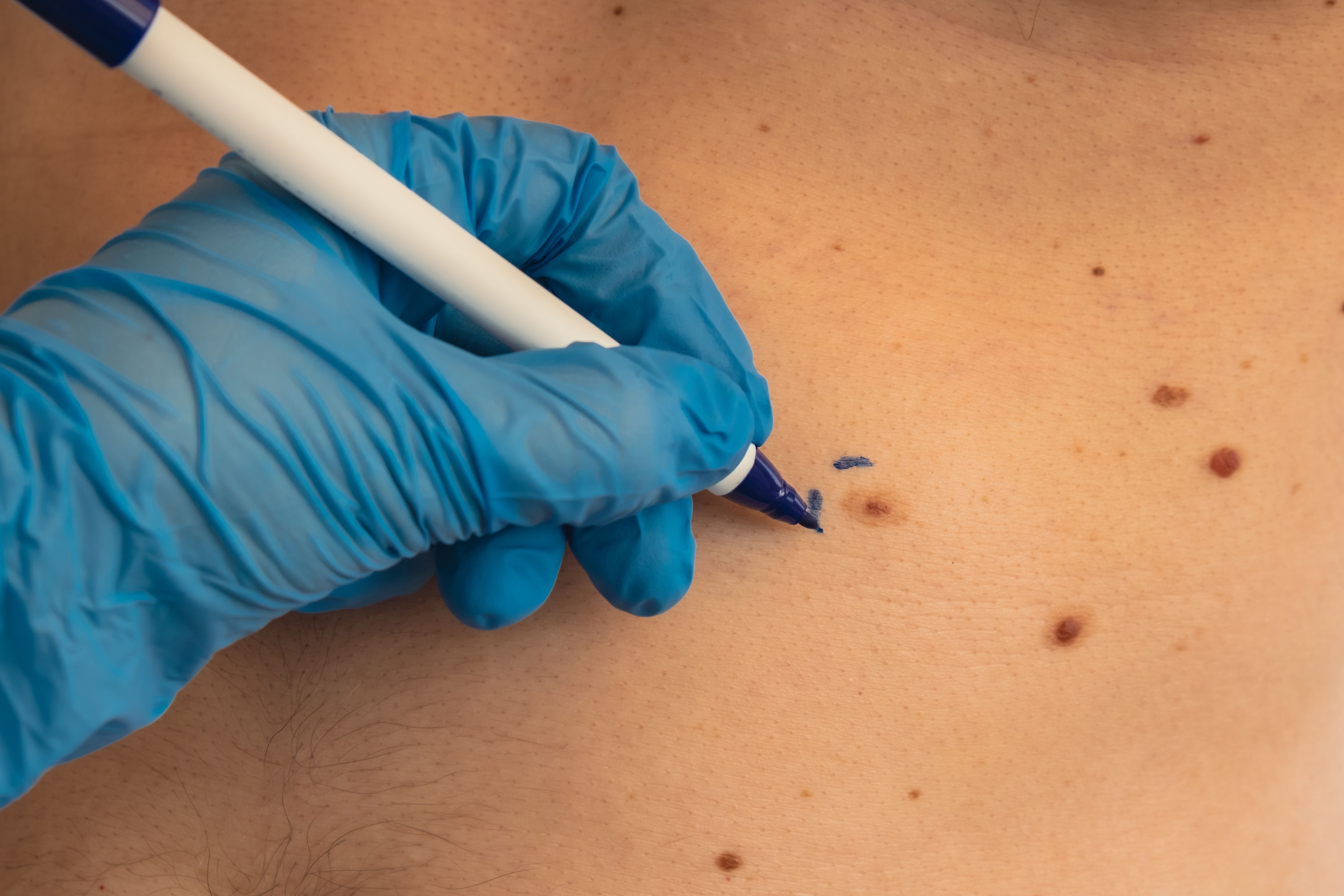 How To Remove Moles On Skin: Safe Remedies & What Actually Works