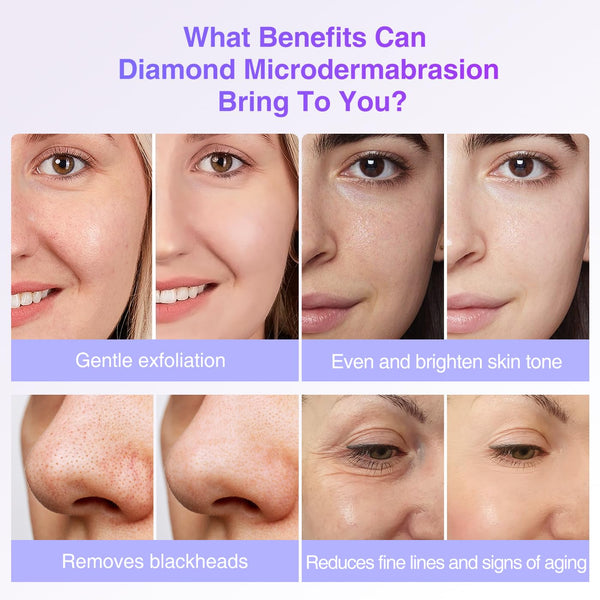 Diamond Microdermabrasion Tips