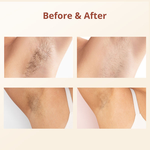 IPL Hair Removal Device With 5 Energy Levels, Large Emission Area for Long-lasting Hair Removal