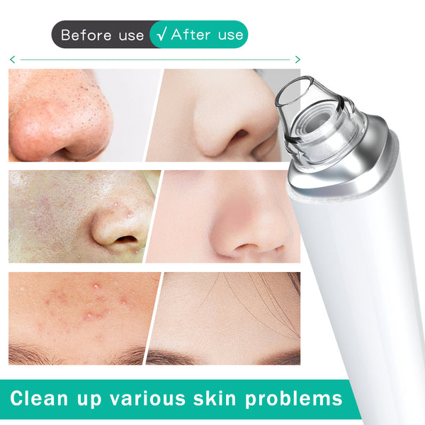 Blackhead Remover Extraction Tool With HD Camera For Visual Blackhead Removal