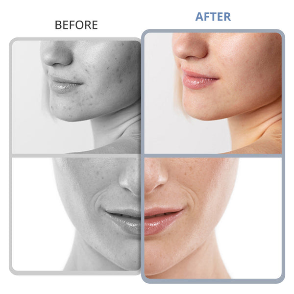 Diamond Microdermabrasion Machine