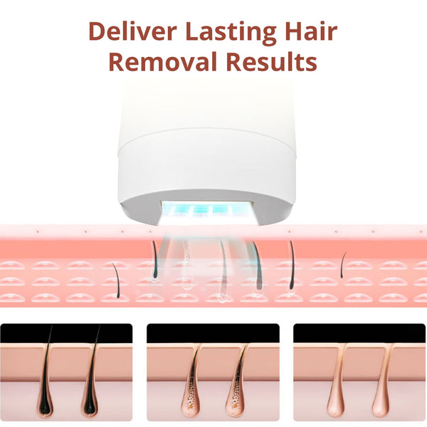 IPL Hair Removal Device With 5 Energy Levels, Large Emission Area for Long-lasting Hair Removal