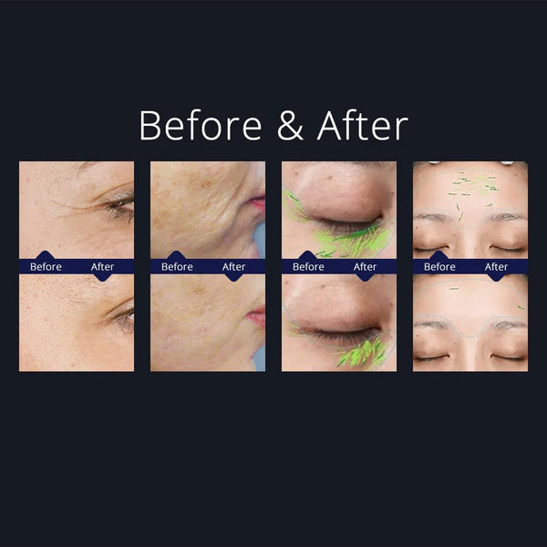 Radio Frequency Skin Tightening Facial Care Beauty Machine