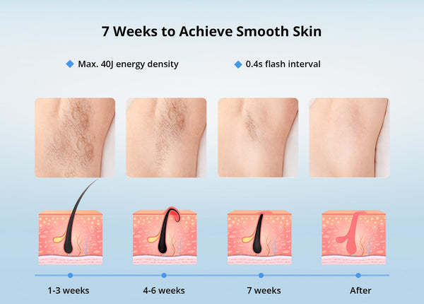 IPL Hair Removal Device With 3 Light Head 10 Energy Level 3 Mode SkinRecognition