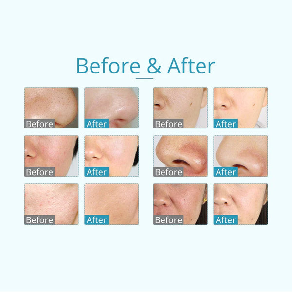 3-In-1 Microdermabrasion Machine