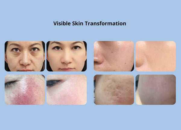 3 In 1 Oxygen Bubble Machine Facial Deep Cleansing Rejuvenation Beauty Machine