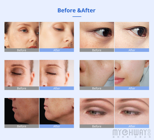 Facial Lifting BIO Microcurrent Therapy Machine Skin Rejuvenation Beauty Machine