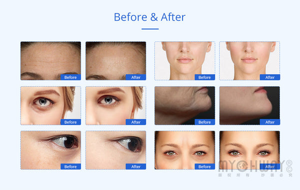2-1 Mini RF Radio Frequency Photon Facial Wrinkle Removal Antiage Beauty Machine