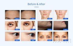 2-1 Mini RF Radio Frequency Photon Facial Wrinkle Removal Antiage Beauty Machine
