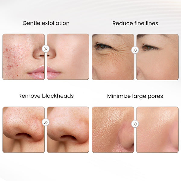 Diamond Microdermabrasion Machine