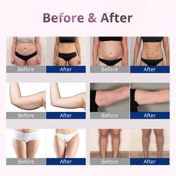 5MW Laser Lipo Machine at Home