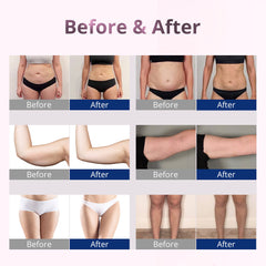 5MW Laser Lipo Machine at Home