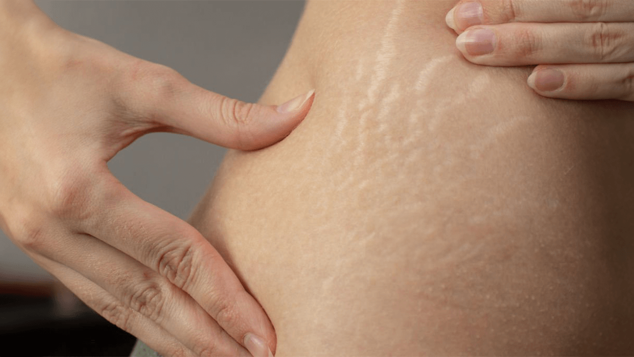 What Causes and How To Remove Stretch Marks-We Have The Answer What Causes and How To Remove Stretch Marks-We Have The Answer