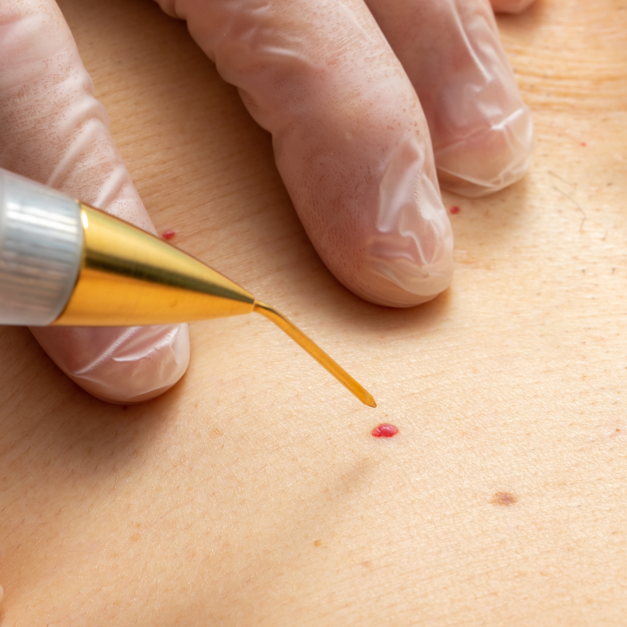 How to Remove Skin Tags at Home Safely?