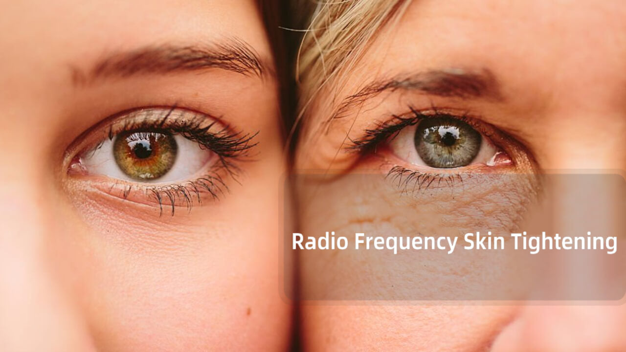 radio frequency skin tightening
