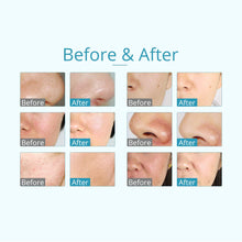 3-In-1 Microdermabrasion Machine