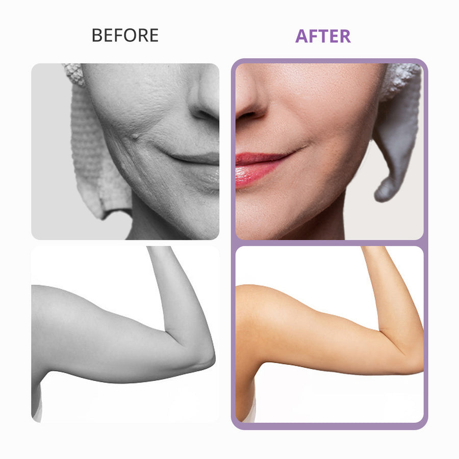 40K Unoisetion Cavitation Machine for Home Use | Surebeauty
