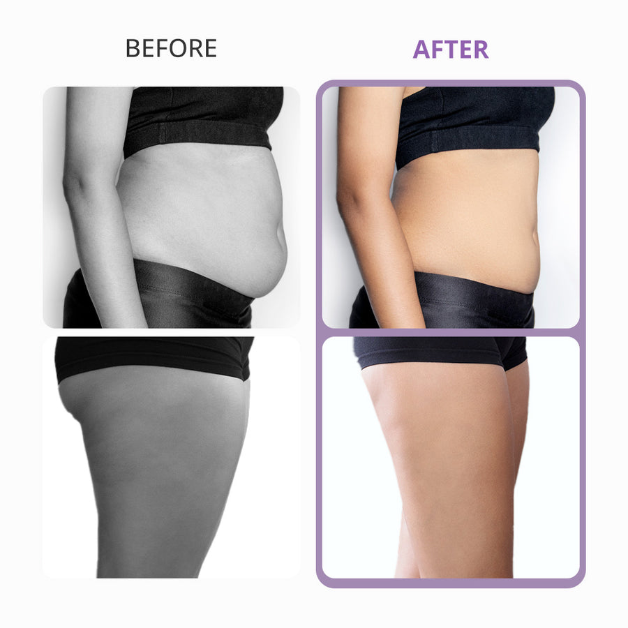 40K Unoisetion Cavitation Machine for Home Use | Surebeauty